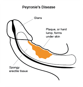 peyronies disease