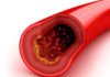 Understanding Cholesterol; Lower It in 3 Easy Steps !!