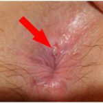 Anal Fissure Image