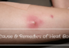 Heat Boil – Causes, Symptoms and Easy Home Remedies Causes and Home Remedies for Heat Boil