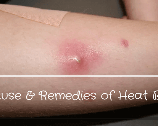 Causes and Home Remedies for Heat Boil