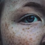 How to Get Rid of Freckles – Easy Ways To Remove Freckles And Moles Get Rid Of Freckles