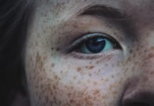 How to Get Rid of Freckles – Easy Ways To Remove Freckles And Moles Get Rid Of Freckles