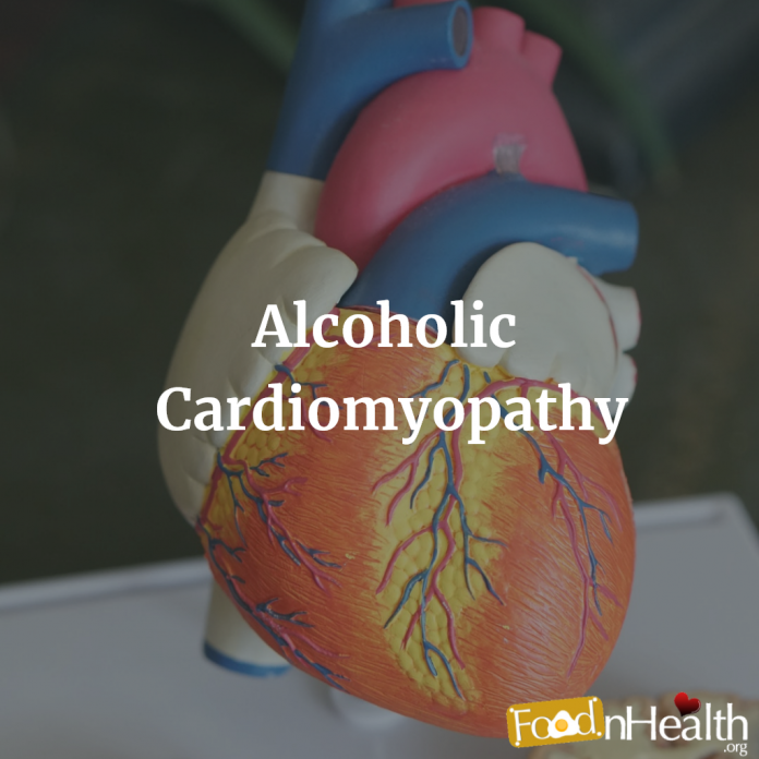 Alcoholic cardiomyopathy is a type of acquired dilated cardiomyopathy associated with long-term heavy alcohol consumption (commonly defined as >80 g per day over a period of at least five years)