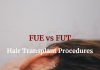 Hair Transplant Procedures – FUE vs FUT Hair Transplant Procedures - FUE vs FUT