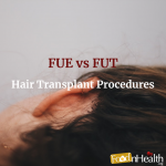 Hair Transplant Procedures – FUE vs FUT Hair Transplant Procedures - FUE vs FUT
