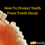 Cavities and Tooth Decay: Symptoms, Causes and Treatment