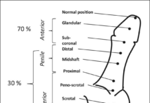 Is Hypospadias a Genetic Condition?