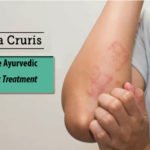 The Best Treatment for Tinea Crusis (Ringworm) of the Groin Effective Ayurvedic Holistic Treatment