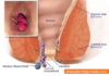 Effective Home Remedies for Hemorrhoids/Piles