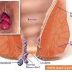 Effective Home Remedies for Hemorrhoids/Piles