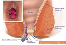 Effective Home Remedies for Hemorrhoids/Piles