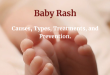 Baby Rash: Causes, Types, Treatments, and Prevention.