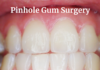 Pinhole Gum Surgery: The Newest Innovative Technique for Gums Pinhole Gum Surgery