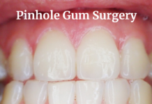 Pinhole Gum Surgery