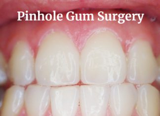 Pinhole Gum Surgery