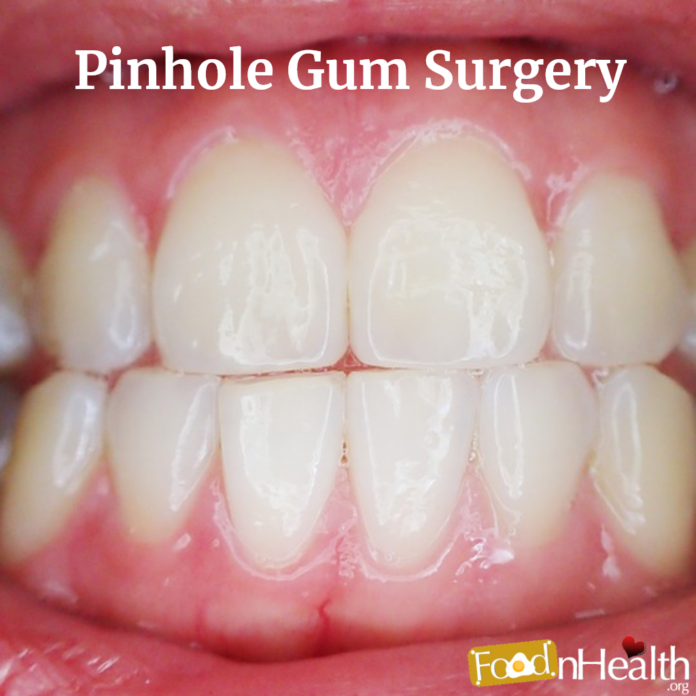 Pinhole Gum Surgery