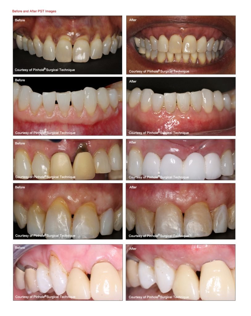Pinhole Gum Surgery - before and after