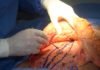 lipo fat removal and tummy tuck