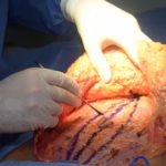 lipo fat removal and tummy tuck