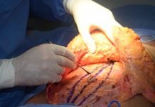 lipo fat removal and tummy tuck