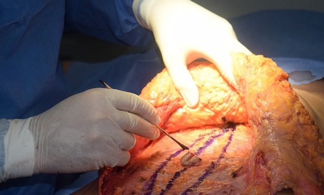 lipo fat removal and tummy tuck