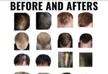 Regrow Your Hair