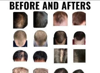 Is It Possible To Regrow Your Hair? Regrow Your Hair