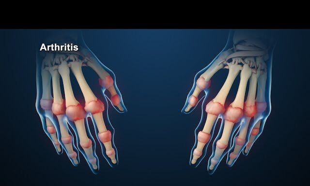 Healthy Habits That All Arthritis Patients Must Follow
