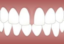 Gap in Your Front Teeth: The Causes and the Solution