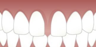 Gap in Your Front Teeth: The Causes and the Solution