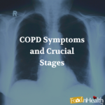 COPD Symptoms and Crucial Stages
