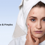 Ayurvedic Tips to Get Rid of Acne and Pimples Acne and Pimples
