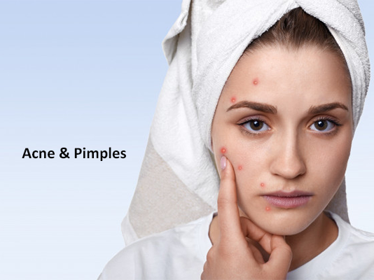 Acne and Pimples