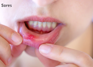 Natural Home Remedies to Treat Mouth Sores
