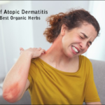 Atopic Dermatitis