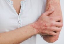 Homeopathic Treatment For Psoriasis