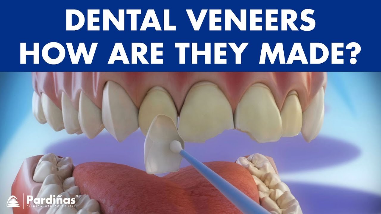 What Are Teeth Veneers Food N Health