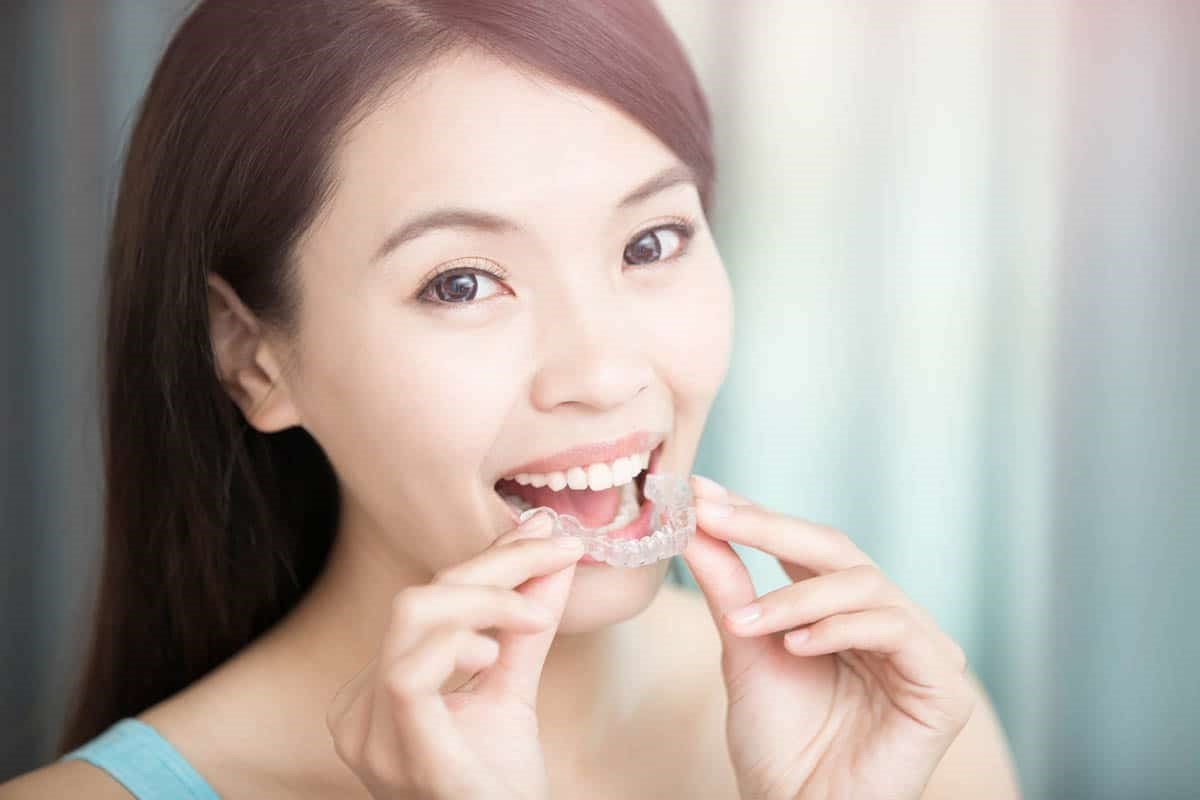 Benefits of Invisalign Braces