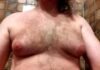 Things Men Need to Know Before Having Gynecomastia Surgery