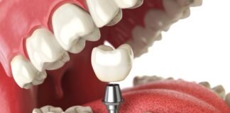 The Costs of Getting a Dental Implant