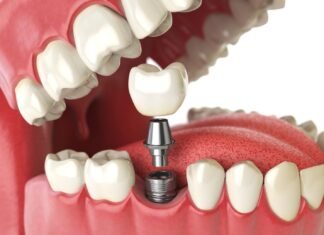 The Costs of Getting a Dental Implant