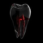 Tooth Root Canal Treatment