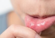 Canker Sores: Causes, Symptoms, And Remedies