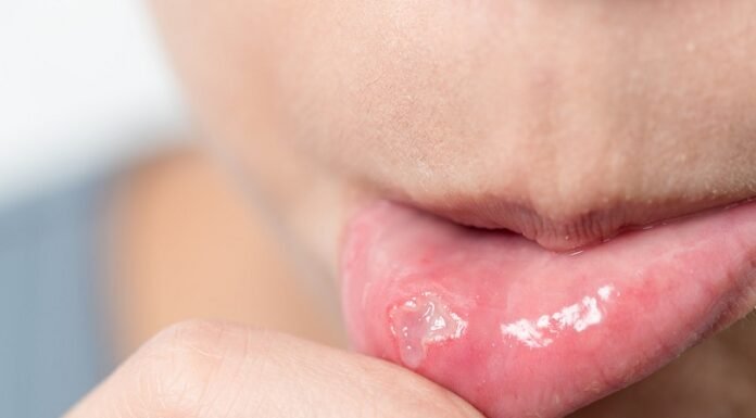 Canker Sores: Causes, Symptoms, And Remedies Canker Sores: Causes, Symptoms, And Remedies