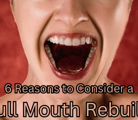 6 Reasons to Consider a Full Mouth Rebuild