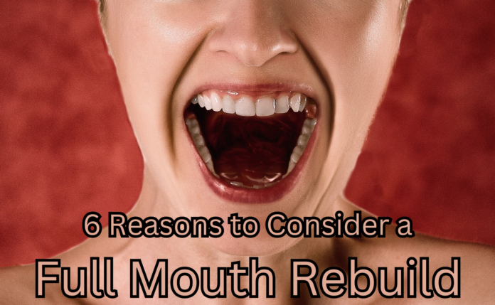 6 Reasons to Consider a Full Mouth Rebuild